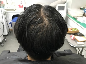 시술 전 젖은머리