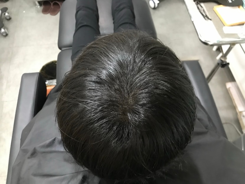 시술 후
