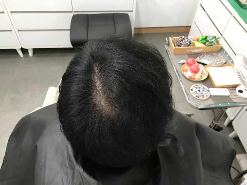 头皮纹身1次手术