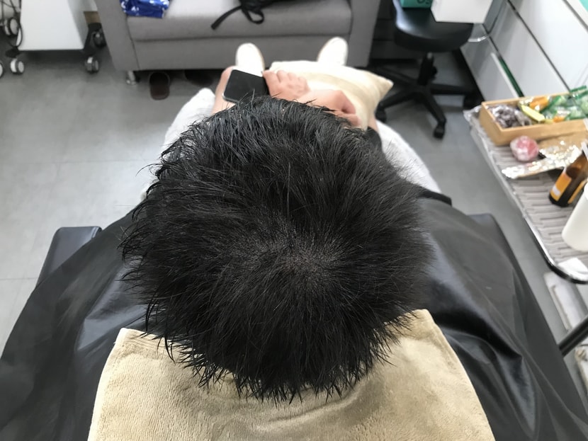 시술 후