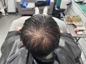 시술 전(젖은머리 상태)