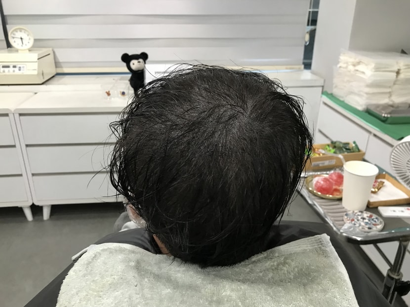 시술 후 사진