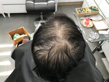 시술 전 사진