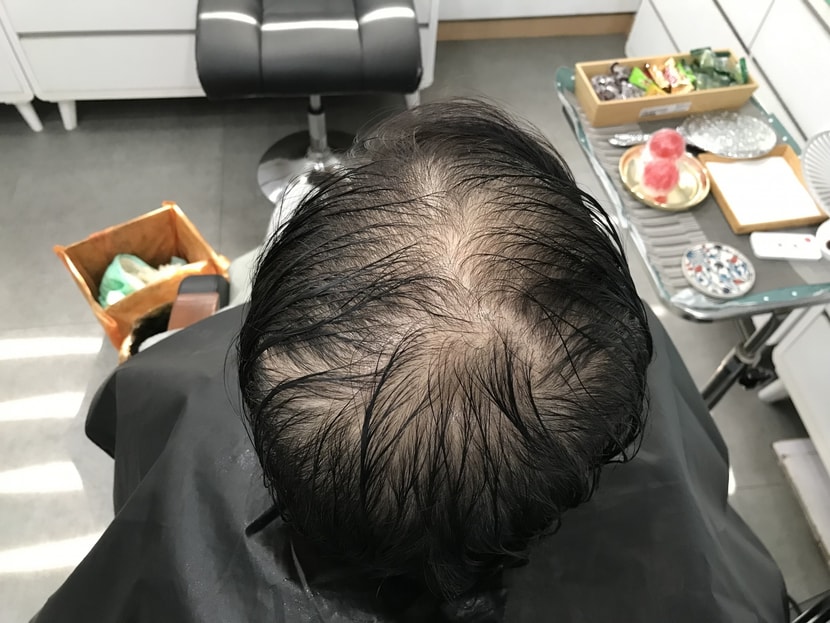 시술 전 사진