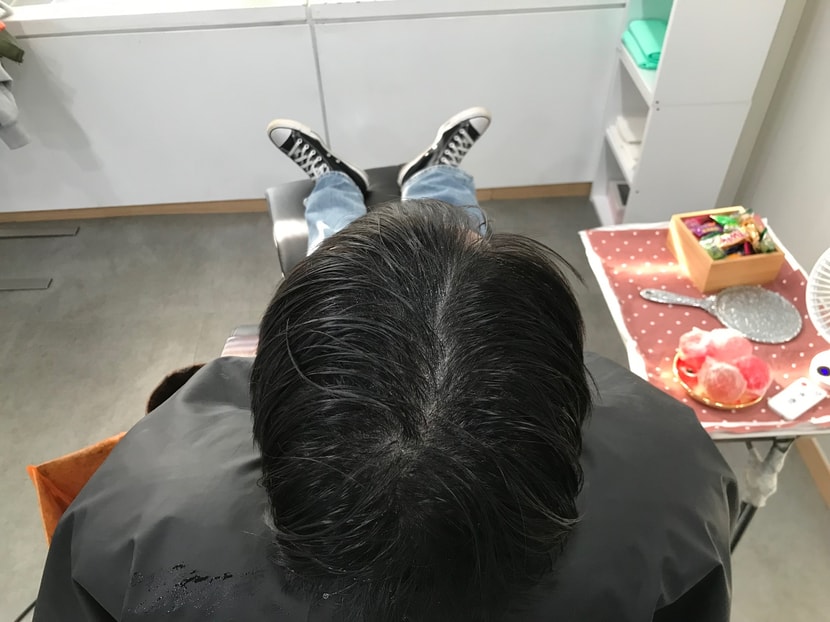 리터치 전 (두피문신 7주차)