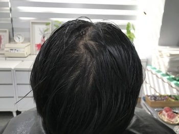 두피문신 전