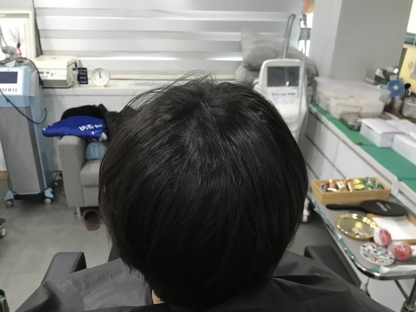 보강시술 후