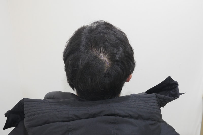 정수리 두피문신