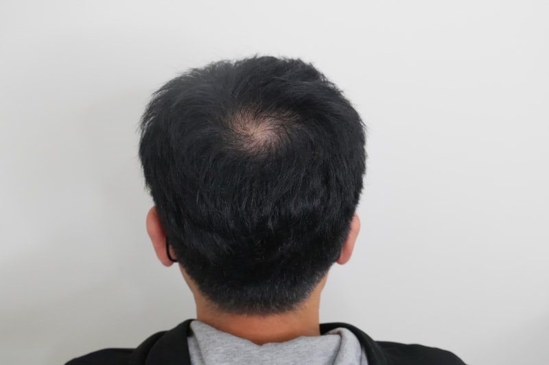 두피문신 후기 입니다.