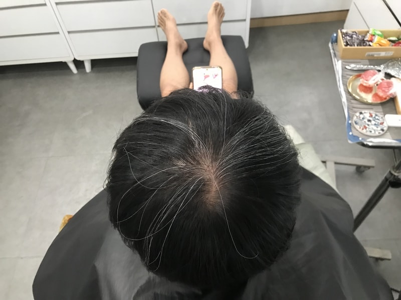 延世ミダインで頭皮の刺青を受ける