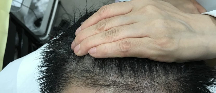 시술전