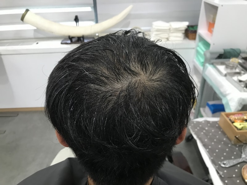延世美达人头皮纹身后记