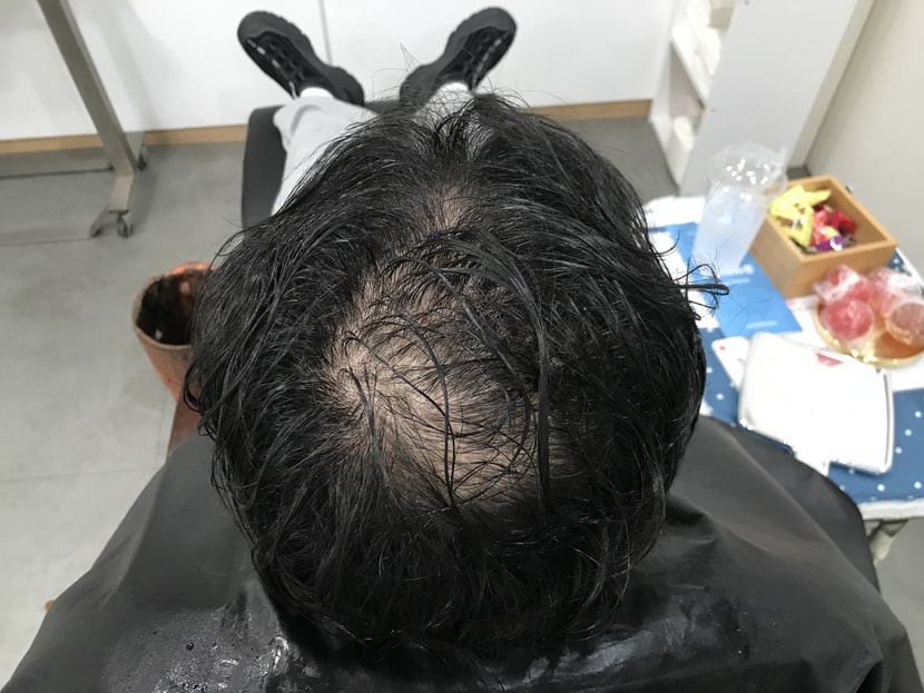 시술전 물에젖은 상태