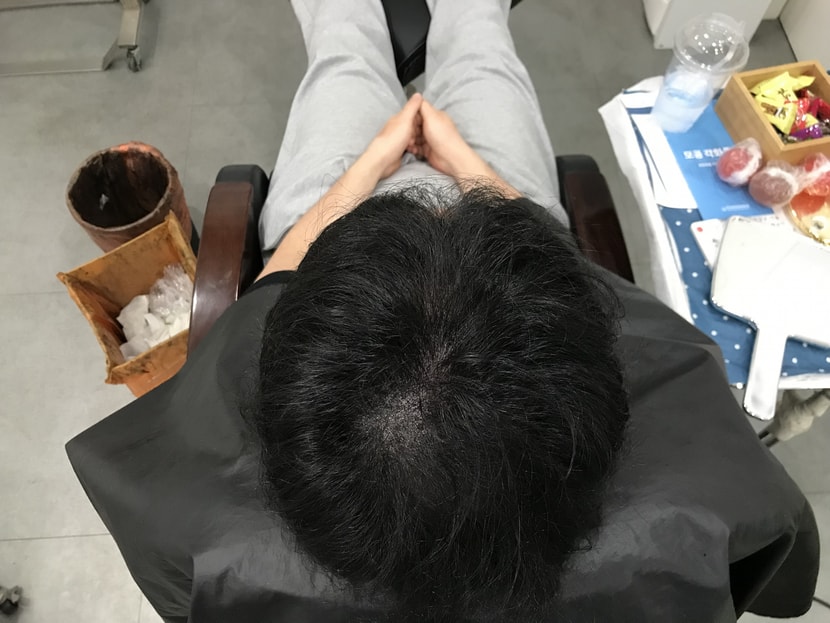 시술후 머리 말린상태