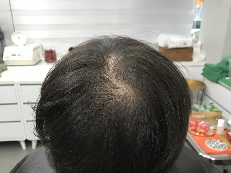 延世美达人头皮纹身后记
