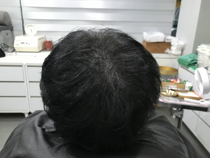 연세미다인  시술 후 사진