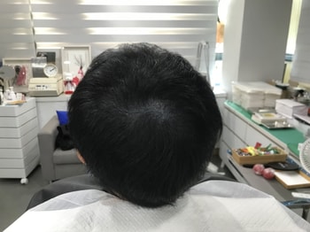 4년후 문신 시술 후 사진
