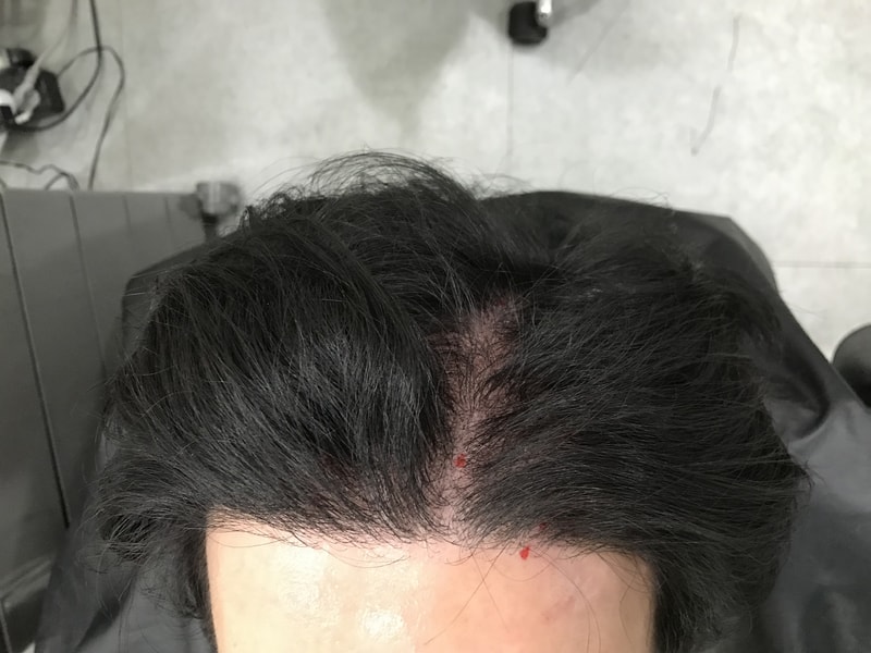 がらんとした分け目マルチプル頭皮タトゥーの後記
