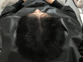 시술 후(과하지 않고 자연스러움)