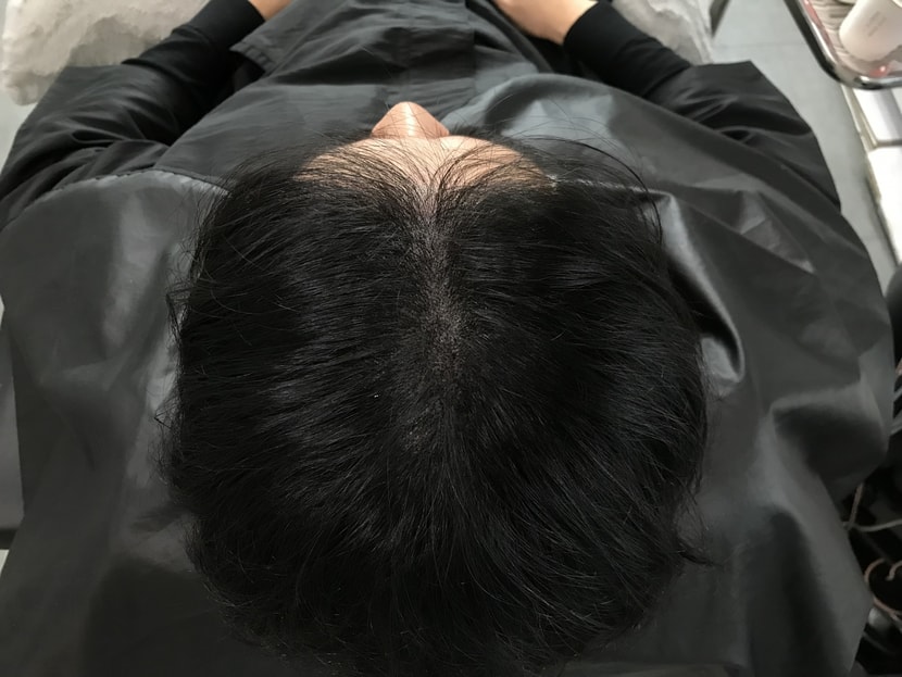 시술 후(과하지 않고 자연스러움)