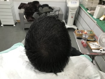 시술후 젖은상태