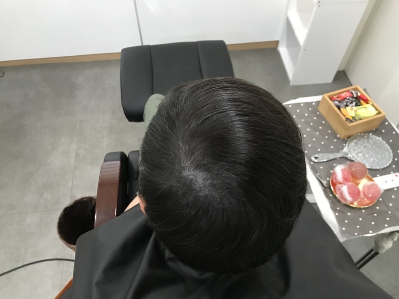 두피문신 2차 리터치 후기입니다