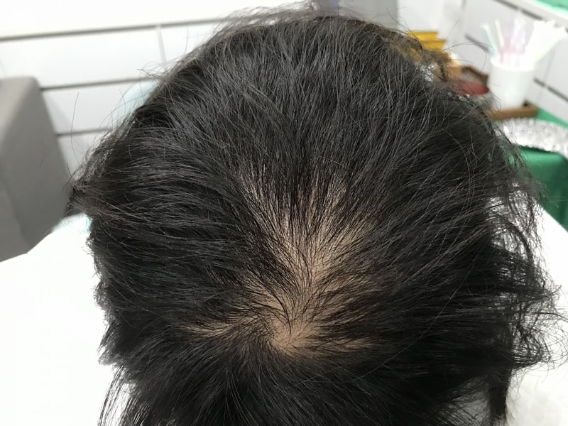 연세미다인 두피문신 5년 후기