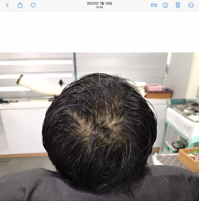 "延世美达人头皮纹身渐变技术2年后期"
