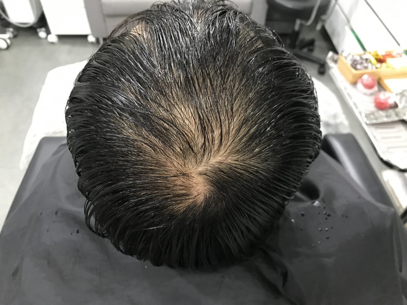 시술후