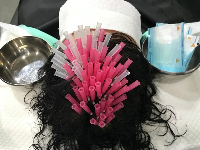 延世美达人头皮纹身后记