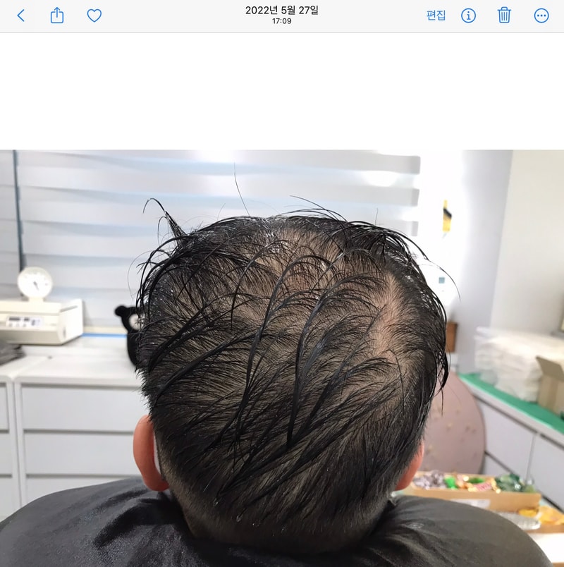 연세미다인 두피문신 4년 후기