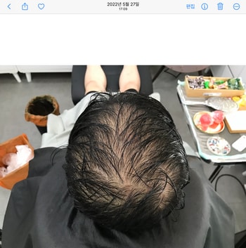 시술 전 젖은 상태 위