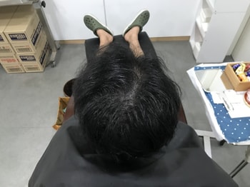 시술전