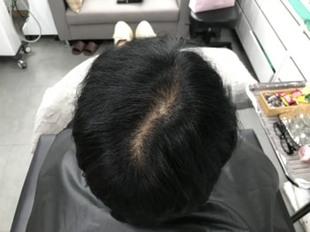 시술전