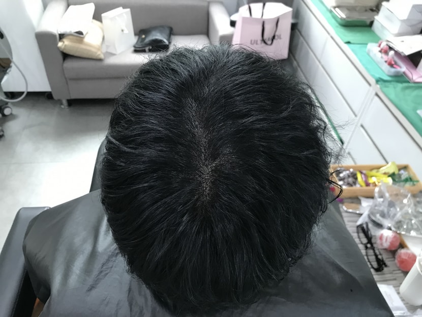 시술후