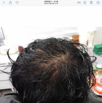 시술전