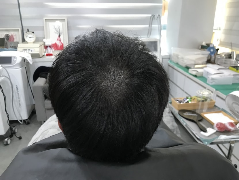 &lt;시술 후 마른머리&gt;