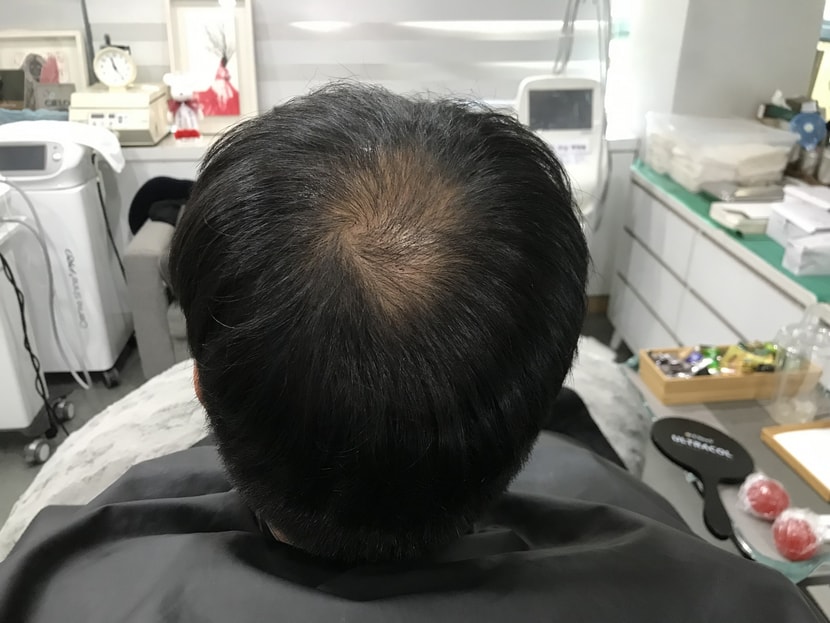 &lt;시술 전 마른머리&gt;