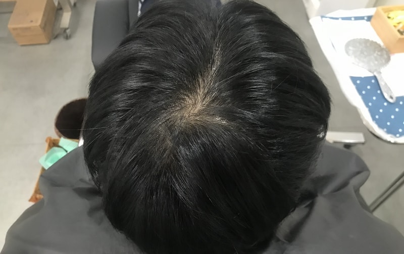 頭皮タトゥーの体験談です
