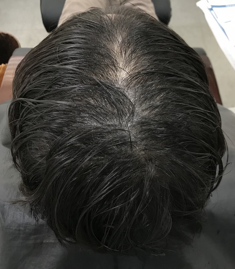 延世美因前头皮纹身、头顶修复后记。