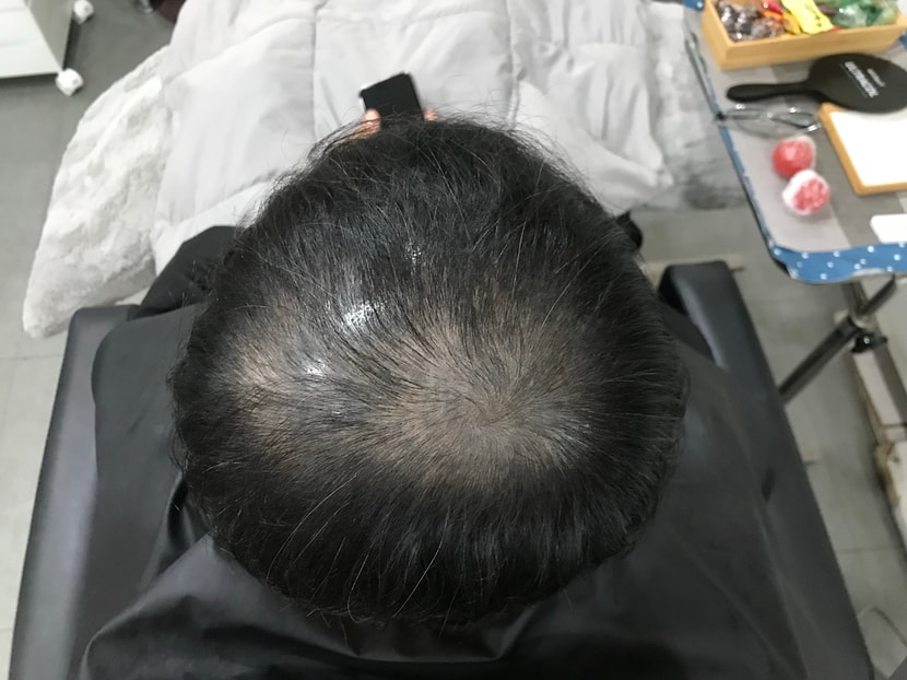 시술전
