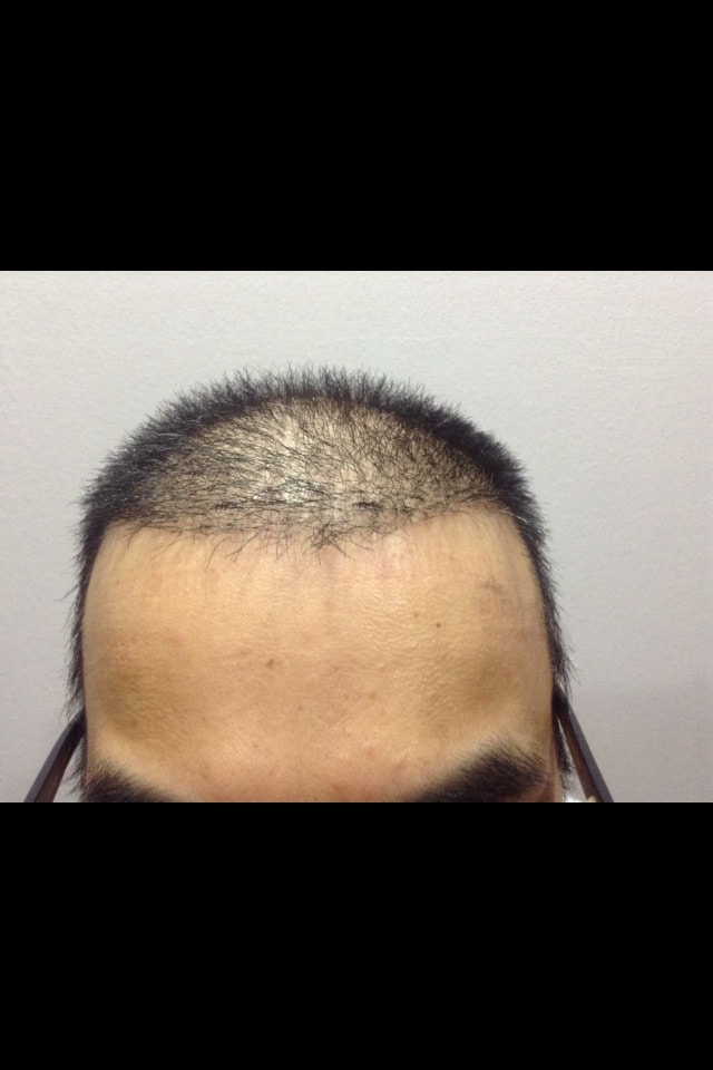 接受了头皮色素管理（前方发际纹身）