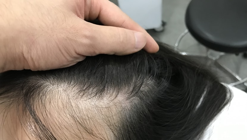 헤어라인문신전