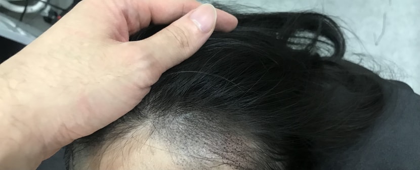 헤어라인문신후