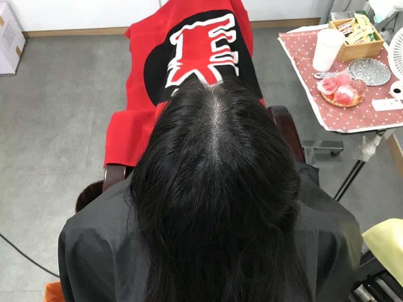 연세미다인 정수리2차