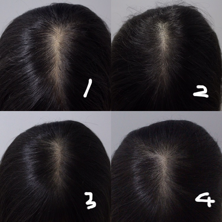 여자 정수리 두피문신 비교사진들고왔습니다!