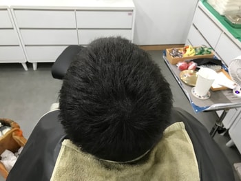 두피문신 시술 후 마른상태2
