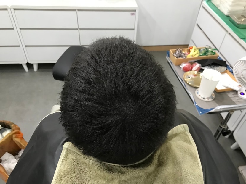 두피문신 시술 후 마른상태2