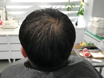 두피문신 시술 전 젖은상태