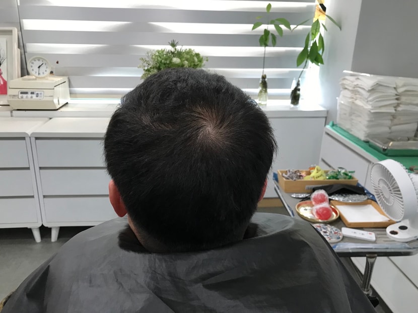 두피문신 시술 전 마른상태